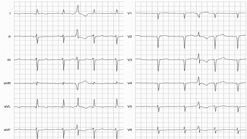 Interpolated VEBS 12 Lead EKG